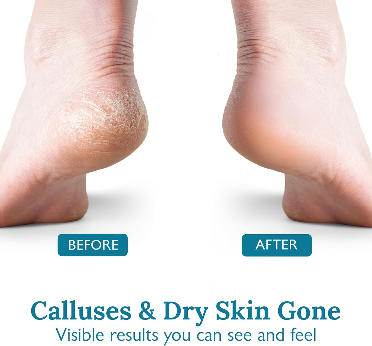 Gilden Tree Foot Callus Remover Kit - 40% Urea Cream & Handmade Terra-Cotta Pumice Stone for Feet - Callus Remover for Feet with Shea Butter & Aloe Vera - Cracked Heel Treatment & Moisturizer