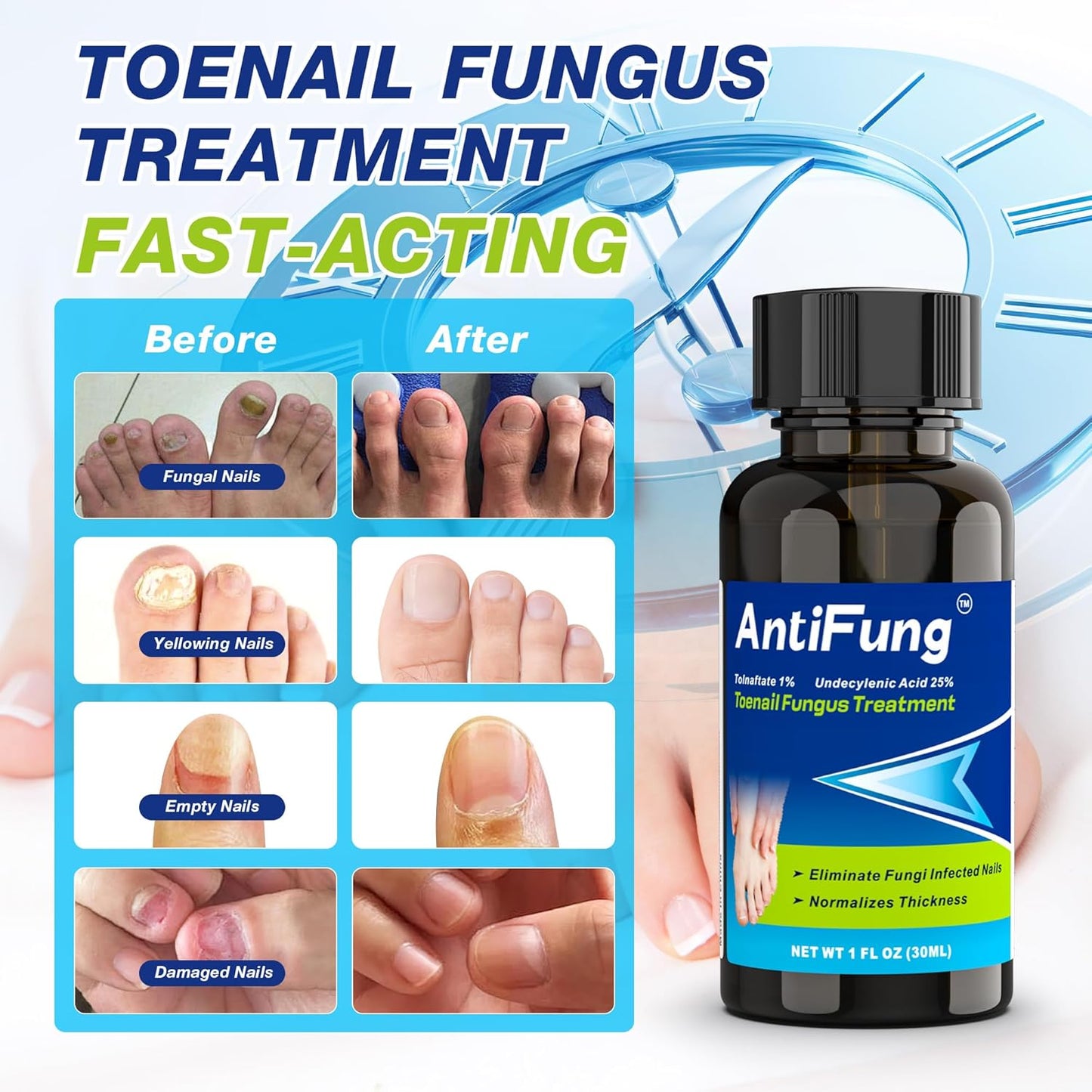Toenail Fungus Treatment Extra Strength – Nail Repair for Damaged Nails, Thick, Yellow, and Discolored Toenails – Fast Acting Formula for Fungus Relief with Tea Tree Oil, 30ml / 1oz