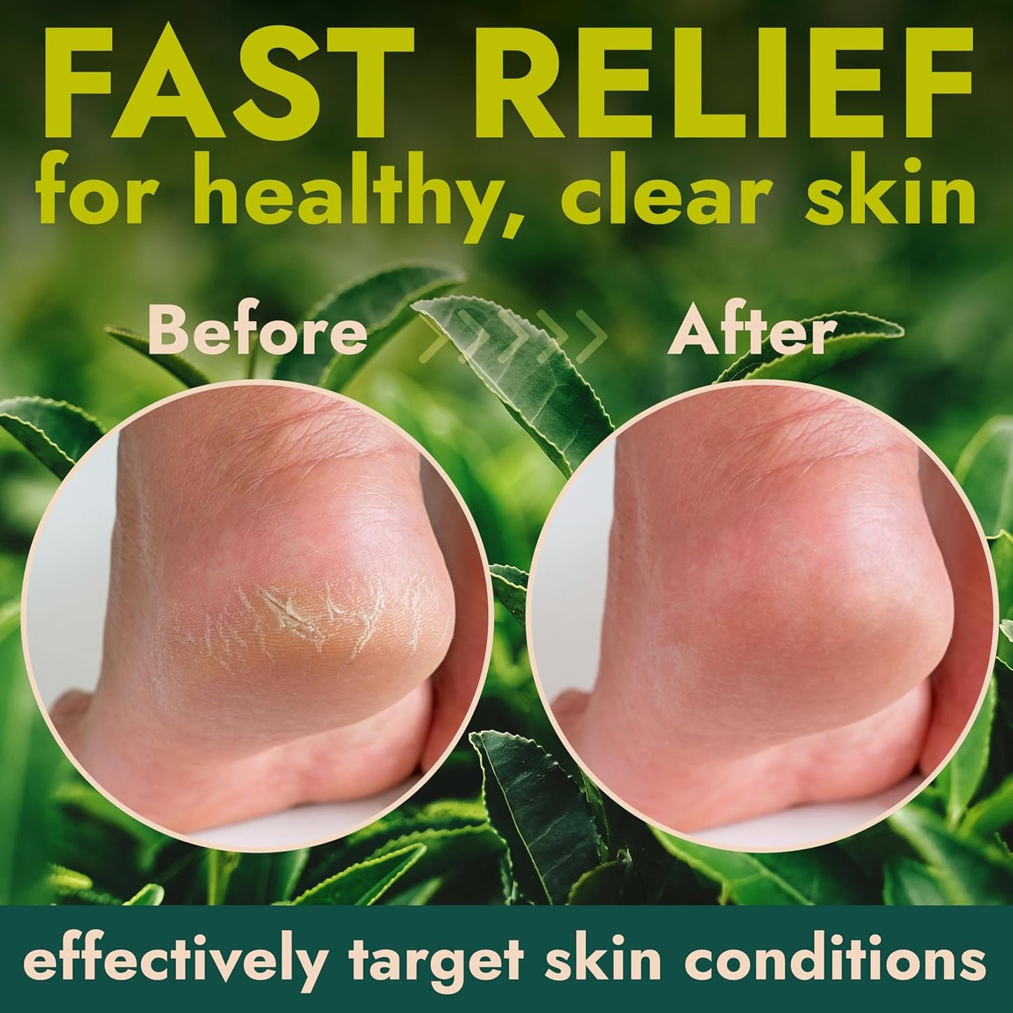 14 Oz Callus Remover Gel+ 3 Free Pumice Stones| Callus Remover For Feet | Tea Tree Professional Grade Foot Exfoliant for Cracked Heels & Dry Feet | Instant Results & Soothing Hydration