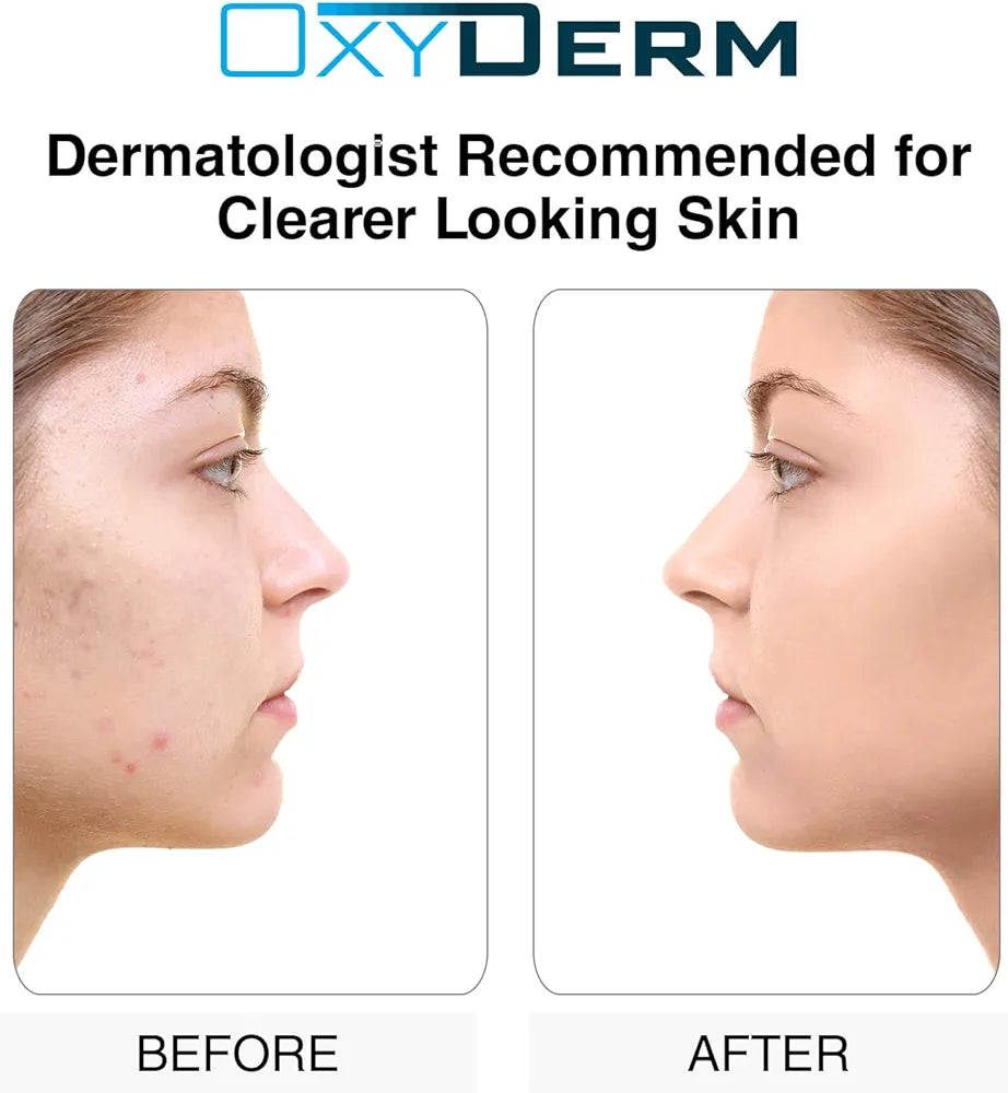 Sulfur Purifying Clay Mask- Deep Pore Cleansing Treatment. Clears Away Acne Blemishes, Clogged Pores, Scars, Oily Skin, Whitehead & Blackhead Pimples for Face & Body with Natural Healing.