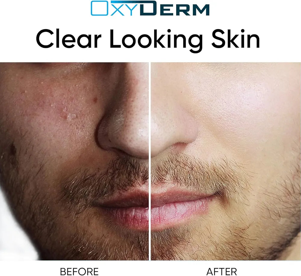 Sulfur Purifying Clay Mask- Deep Pore Cleansing Treatment. Clears Away Acne Blemishes, Clogged Pores, Scars, Oily Skin, Whitehead & Blackhead Pimples for Face & Body with Natural Healing.